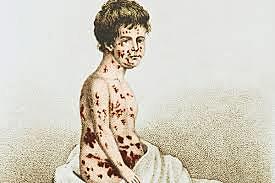 Smallpox Disaster