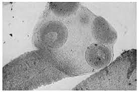 Taenia Saginata