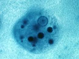 Entamoeba Histolytica