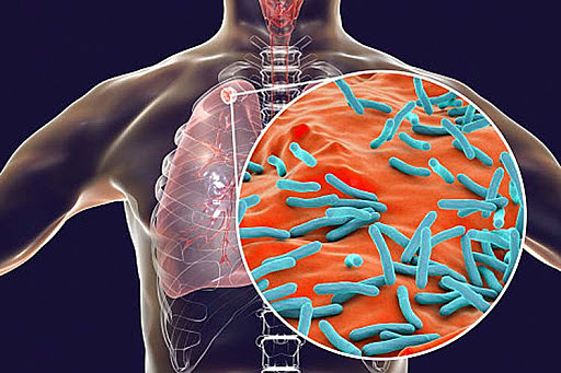 DESCUBRIMIENTO DE LA TUBERCULOSIS