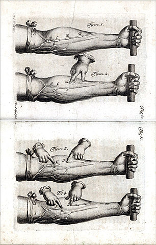 Primera inyección de droga intravenosa en el cuerpo humano