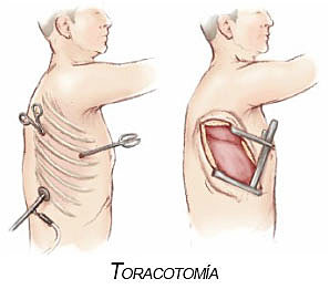 Francisco Romero realiza la primera intervención cardíaca con éxito (toracotomía seguida de pericardiectomía)