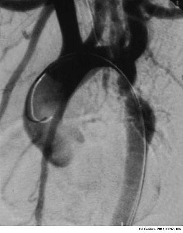 C.Crafoord realizo una coartación de aorta