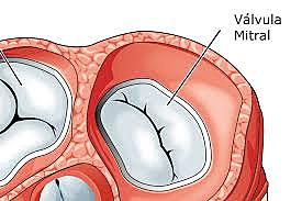 Harken realizó la primera comisurotomía mitral con éxito