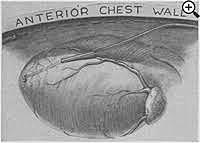 A. Vineberg implantó la arteria mamaria interna a través de un túnel de miocardio, sin anastomosarla a ninguna arteria coronaria