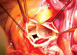 V.I. Kolessov publicó su experiencia en cirugía de bypass coronario anastomosando la arteria mamaria con las coronarias