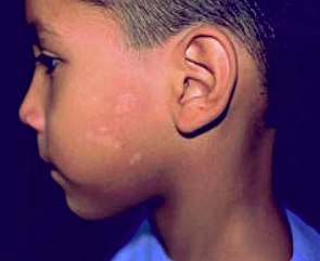 PITIRIASIS VERSICOLOR