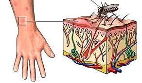 Situación de la fiebre amarilla África