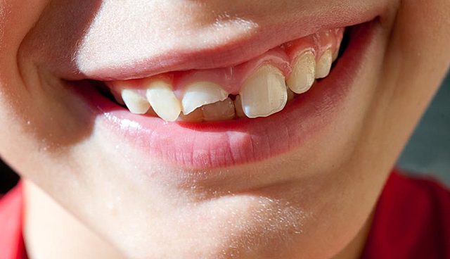 la vez que me rompí mi diente permanente