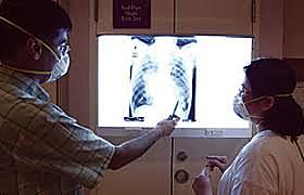 SARS (SÍNDROME AGUDO RESPIRATORIO SEVERO)