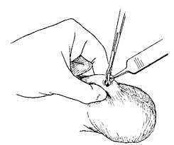 VASECTOMIA: CONTROLADOR DE FERTILIDAD MASCULINA