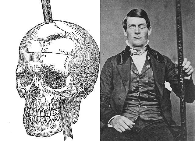 Phineas Gage y el enigma del córtex prefrontal (Elsevier.es - A. garcía-Molina - 2012)
