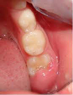Comienzo de dentición mixta