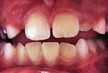 Erupción del Incisivo Lateral Permanente