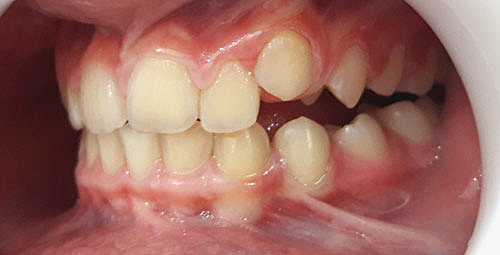 Recambio del Sector Lateral