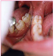 Erupción de segundo molar