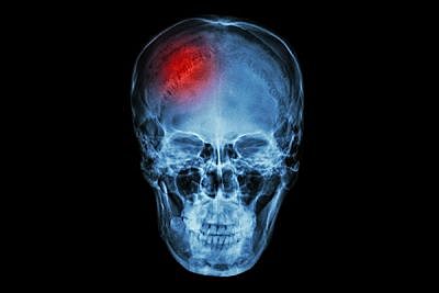Lesión cerebral mediante pruebas neuropsicológicas.