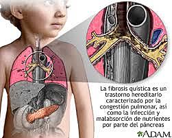 Se aprueban DNAsas para tratar fibrosis quística