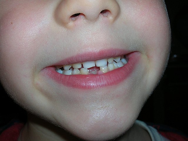 My first tooth fell out