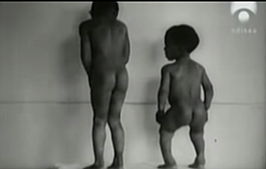 RAQUITISMO-EDAD MODERNA