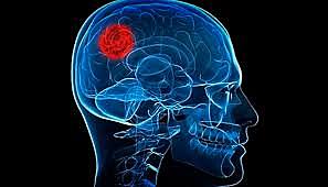 Descripciones vinculadas a las secuelas posibles de daño cerebral