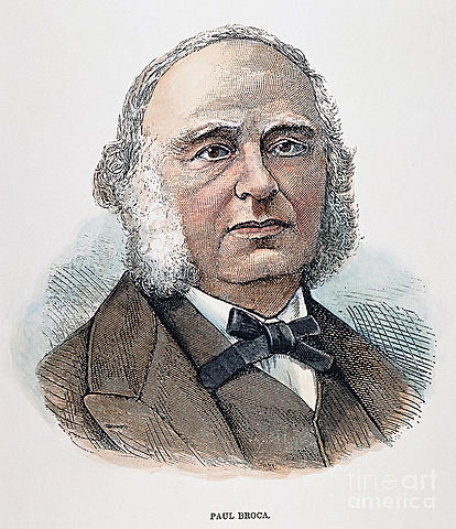 Broca declaró que “La afemia se relaciona con lesiones de la tercera circunvolución frontal del hemisferio izquierdo del cerebro”.