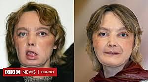 Primer trasplante parcial de un rostro humano.