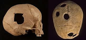 Egipcios hacía trepanaciones para estudiar el contenido del cerebro.