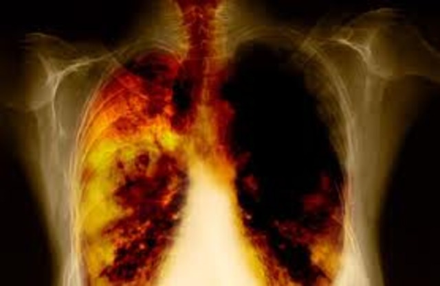 Lung cancer by far biggest killer