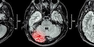 Relación entre trastorno y lesiones anatómicas