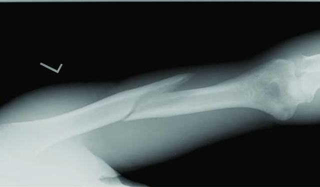 Tomografía de brazo fracturado