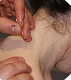 Acupuntura (Medicina alternativa)