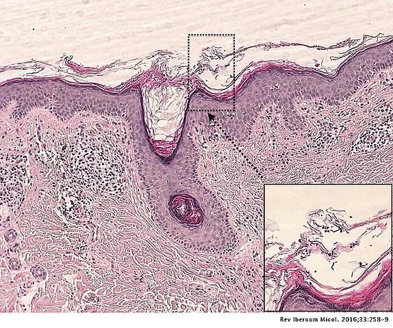 PITIRIASIS VERSICOLOR