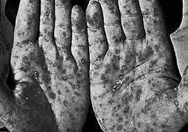 Demostración de el treponema pallidum es el productor de la sífilis.