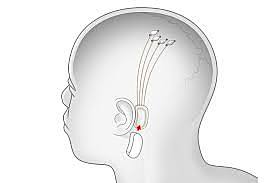 Telepatía artificial: Neurolink