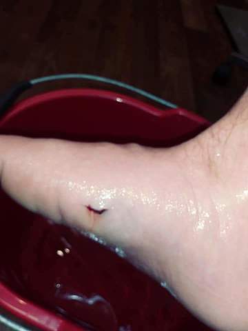 I got stung by a stingray