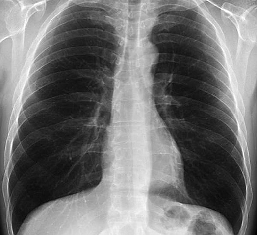 Avances en la Radiología Pulmonar