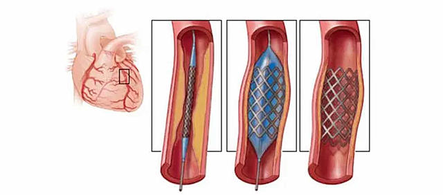 Cateterismo Cardíaco