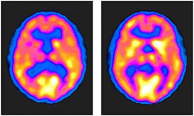 Tomografía por Emisión de Positrones