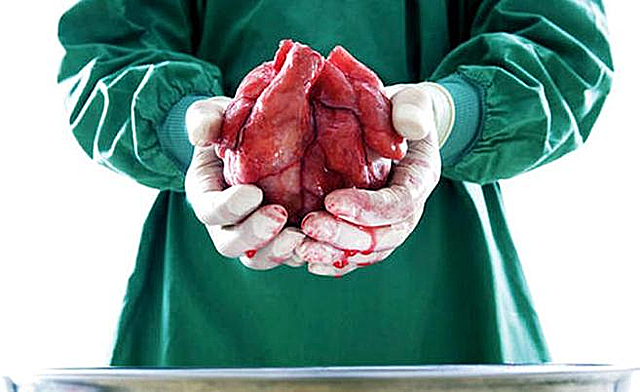 PRIMER TRANSPLANTE DE CORAZON