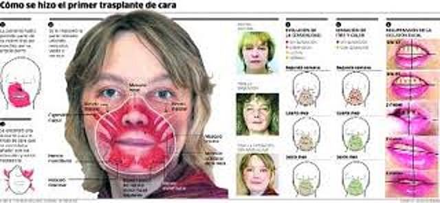 TRANSPLANTE DE CARA COMPLETO