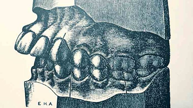 Clasificación de Angle
