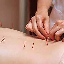 Medicina Tradicional China ( Acupuntura)