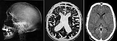 Sir Godfrey Hounsfield y el  Dr. Jamie Ambrose