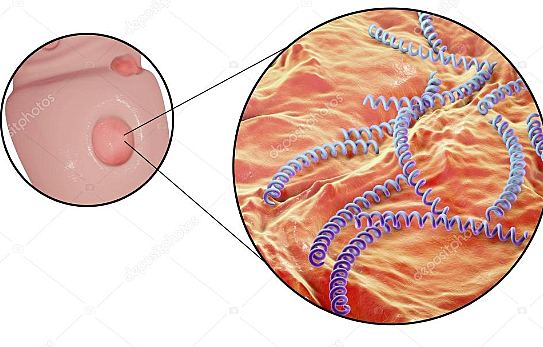 Sífilis (renacimiento)