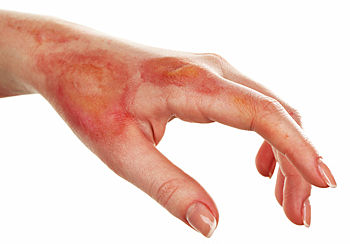 Lesiones debido a la radiación