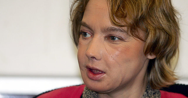 First Facial Transplant