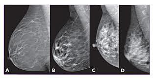 Equipo de Mamografía o Mastografía