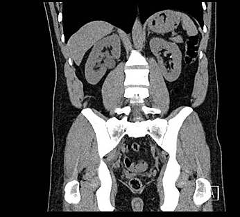 Tomografia Axial Computarizada