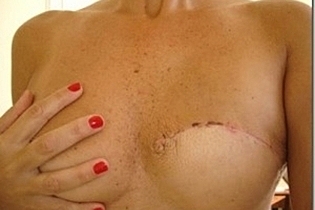 Extirpación de una mama completa por Cáncer